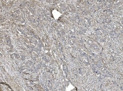 IHC staining of FFPE human breast cancer with FLNA antibody. HIER: boil tissue sections in pH8 EDTA for 20 min and allow to cool before testing.