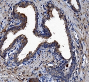 IHC staining of FFPE human prostate cancer with CES1 antibody. HIER: boil tissue sections in pH8 EDTA for 20 min and allow to cool before testing.