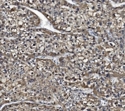 IHC staining of FFPE human liver cancer with CES1 antibody. HIER: boil tissue sections in pH8 EDTA for 20 min and allow to cool before testing.