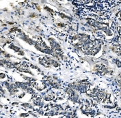 IHC staining of FFPE human breast cancer with PEPCK2 antibody. HIER: boil tissue sections in pH8 EDTA for 20 min and allow to cool before testing.