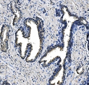 IHC staining of FFPE human prostate cancer with PEPCK2 antibody. HIER: boil tissue sections in pH8 EDTA for 20 min and allow to cool before testing.