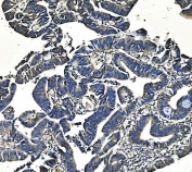 IHC staining of FFPE human rectal cancer with PEPCK2 antibody. HIER: boil tissue sections in pH8 EDTA for 20 min and allow to cool before testing.
