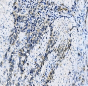 IHC staining of FFPE human gastric cancer with EIF4A1 antibody. HIER: boil tissue sections in pH8 EDTA for 20 min and allow to cool before testing.
