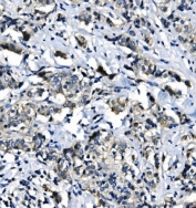 IHC staining of FFPE human breast cancer with EIF4A1 antibody. HIER: boil tissue sections in pH8 EDTA for 20 min and allow to cool before testing.