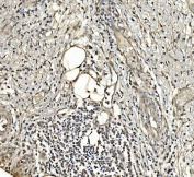 IHC staining of FFPE human rectal cancer with ALDOA antibody. HIER: boil tissue sections in pH8 EDTA for 20 min and allow to cool before testing.