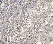 IHC staining of FFPE human liver cancer with ALDOA antibody. HIER: boil tissue sections in pH8 EDTA for 20 min and allow to cool before testing.