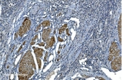 IHC staining of FFPE human bladder cancer with ACTA1 antibody. HIER: boil tissue sections in pH8 EDTA for 20 min and allow to cool before testing.