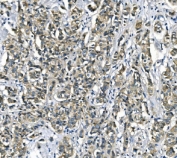 IHC staining of FFPE human breast cancer with Argininosuccinate Synthetase 1 antibody. HIER: boil tissue sections in pH8 EDTA for 20 min and allow to cool before testing.