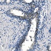IHC staining of FFPE human prostate cancer with Argininosuccinate Synthetase 1 antibody. HIER: boil tissue sections in pH8 EDTA for 20 min and allow to cool before testing.