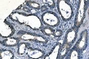 IHC staining of FFPE human colon cancer with ASS1 antibody. HIER: boil tissue sections in pH8 EDTA for 20 min and allow to cool before testing.