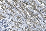 IHC staining of FFPE human breast cancer with eRF1 antibody. HIER: boil tissue sections in pH8 EDTA for 20 min and allow to cool before testing.
