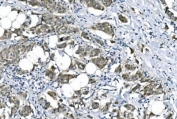 IHC staining of FFPE human breast cancer with eRF1 antibody. HIER: boil tissue sections in pH8 EDTA for 20 min and allow to cool before testing.
