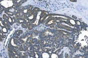 IHC staining of FFPE human ovarian cancer with eRF1 antibody. HIER: boil tissue sections in pH8 EDTA for 20 min and allow to cool before testing.
