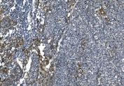 IHC staining of FFPE human lung cancer with eRF1 antibody. HIER: boil tissue sections in pH8 EDTA for 20 min and allow to cool before testing.