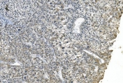 IHC staining of FFPE human liver cancer with eRF1 antibody. HIER: boil tissue sections in pH8 EDTA for 20 min and allow to cool before testing.