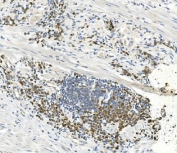 IHC staining of FFPE human lymph node metastasis in rectal cancer with EEF2 antibody. HIER: boil tissue sections in pH8 EDTA for 20 min and allow to cool before testing.
