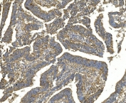 IHC staining of FFPE human rectal cancer with EEF2 antibody. HIER: boil tissue sections in pH8 EDTA for 20 min and allow to cool before testing.