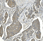 IHC staining of FFPE human breast cancer with EEF2 antibody. HIER: boil tissue sections in pH8 EDTA for 20 min and allow to cool before testing.