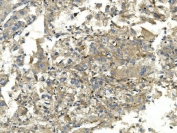IHC staining of FFPE human liver cancer with EEF2 antibody. HIER: boil tissue sections in pH8 EDTA for 20 min and allow to cool before testing.