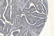IHC staining of FFPE human rectal cancer with APPL1 antibody. HIER: boil tissue sections in pH8 EDTA for 20 min and allow to cool before testing.