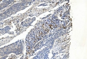 IHC staining of FFPE human breast cancer with APPL1 antibody. HIER: boil tissue sections in pH8 EDTA for 20 min and allow to cool before testing.