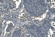 IHC staining of FFPE human lung cancer with ANPEP antibody. HIER: boil tissue sections in pH8 EDTA for 20 min and allow to cool before testing.