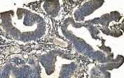 IHC staining of FFPE human rectal cancer with ANPEP antibody. HIER: boil tissue sections in pH8 EDTA for 20 min and allow to cool before testing.