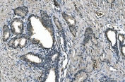 IHC staining of FFPE human prostate cancer with Carbonic Anhydrase I antibody. HIER: boil tissue sections in pH8 EDTA for 20 min and allow to cool before testing.
