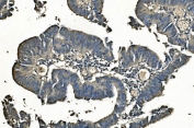 IHC staining of FFPE human rectal cancer with Carbonic Anhydrase I antibody. HIER: boil tissue sections in pH8 EDTA for 20 min and allow to cool before testing.