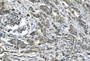 IHC staining of FFPE human breast cancer with Carbonic Anhydrase I antibody. HIER: boil tissue sections in pH8 EDTA for 20 min and allow to cool before testing.