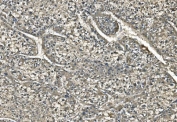 IHC staining of FFPE human liver cancer with Carbonic Anhydrase I antibody. HIER: boil tissue sections in pH8 EDTA for 20 min and allow to cool before testing.