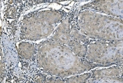 IHC staining of FFPE human esophageal squamous carcinoma with Carbonic Anhydrase I antibody. HIER: boil tissue sections in pH8 EDTA for 20 min and allow to cool before testing.