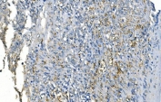 IHC staining of FFPE human gastric cancer with CA1 antibody. HIER: boil tissue sections in pH8 EDTA for 20 min and allow to cool before testing.
