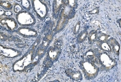 IHC staining of FFPE human colon cancer with CA1 antibody. HIER: boil tissue sections in pH8 EDTA for 20 min and allow to cool before testing.