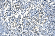 IHC staining of FFPE human pancreatic cancer with CA1 antibody. HIER: boil tissue sections in pH8 EDTA for 20 min and allow to cool before testing.