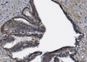 IHC staining of FFPE human prostate cancer with AFAP1 antibody. HIER: boil tissue sections in pH8 EDTA for 20 min and allow to cool before testing.