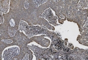 IHC staining of FFPE human lung cancer with Cadherin 2 antibody. HIER: boil tissue sections in pH8 EDTA for 20 min and allow to cool before testing.
