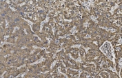 IHC staining of FFPE human liver cancer with Cadherin 2 antibody. HIER: boil tissue sections in pH8 EDTA for 20 min and allow to cool before testing.
