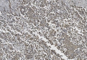 IHC staining of FFPE human pancreatic cancer with Cadherin 2 antibody. HIER: boil tissue sections in pH8 EDTA for 20 min and allow to cool before testing.