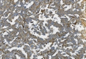 IHC staining of FFPE human ovarian cancer with K-Cadherin antibody. HIER: boil tissue sections in pH8 EDTA for 20 min and allow to cool before testing.