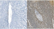 IHC staining of FFPE human liver cancer with Cadherin 11 antibody. HIER: boil tissue sections in pH8 EDTA for 20 min and allow to cool before testing.