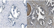 IHC staining of FFPE human prostate cancer with Cadherin 11 antibody. HIER: boil tissue sections in pH8 EDTA for 20 min and allow to cool before testing.