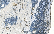 IHC staining of FFPE human ovarian carcinoma with Cadherin 13 antibody. HIER: boil tissue sections in pH8 EDTA for 20 min and allow to cool before testing.