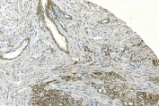 IHC staining of FFPE human renal carcinoma with Cadherin 13 antibody. HIER: boil tissue sections in pH8 EDTA for 20 min and allow to cool before testing.