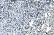 IHC staining of FFPE human gastric cancer with Cadherin 13 antibody. HIER: boil tissue sections in pH8 EDTA for 20 min and allow to cool before testing.