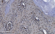 IHC staining of FFPE human esophageal squamous carcinoma with CDK13 antibody. HIER: boil tissue sections in pH8 EDTA for 20 min and allow to cool before testing.