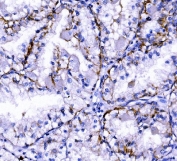 IHC staining of FFPE human renal clear cell carcinoma tissue with Claudin 7 antibody. HIER: boil tissue sections in pH8 EDTA for 20 min and allow to cool before testing.