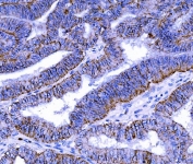 IHC staining of FFPE human rectal cancer tissue with Claudin 7 antibody. HIER: boil tissue sections in pH8 EDTA for 20 min and allow to cool before testing.