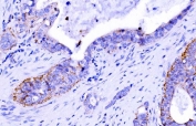 IHC staining of FFPE human gallbladder adenocarcinoma tissue with Claudin 7 antibody. HIER: boil tissue sections in pH8 EDTA for 20 min and allow to cool before testing.