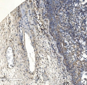 IHC staining of FFPE human melanoma tissue with COL7A1 antibody. HIER: boil tissue sections in pH8 EDTA for 20 min and allow to cool before testing.